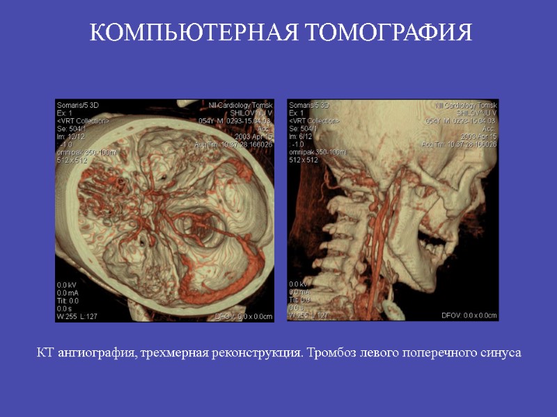 КТ ангиография, трехмерная реконструкция. Тромбоз левого поперечного синуса КОМПЬЮТЕРНАЯ ТОМОГРАФИЯ